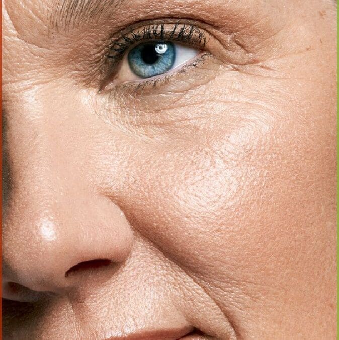 Forever Young: How The Skin Nurse Australia Uses BBL Hero & SkinTyte for Ageing Skin