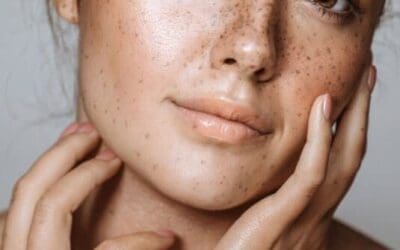 Struggling with Pigmentation? Discover Effective Removal Options in Perth
