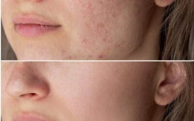 Book the Best Hydrafacial in Perth for Acne Scars & Glowing Skin
