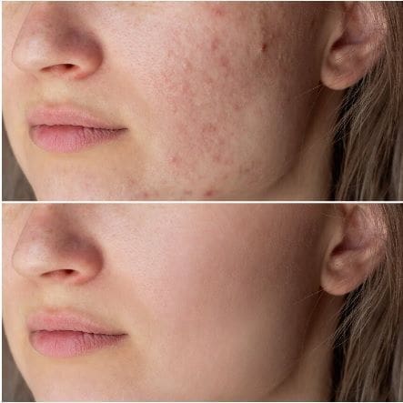 Book the Best Hydrafacial in Perth for Acne Scars & Glowing Skin