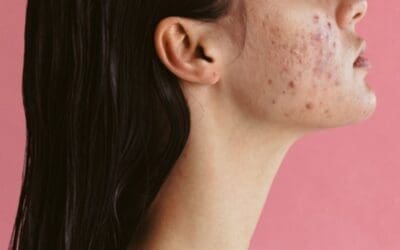 Hormonal Breakouts: How The Skin Nurse Helps You Get Control Back